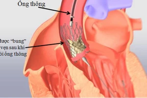 Thay van tim qua ống thông giúp rút ngắn thời gian điều trị