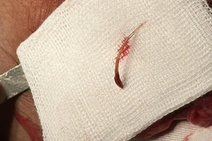 Hiếm gặp nuốt xương cá trôi xuống ruột thừa gây viêm nhiễm