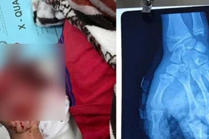 Đêm giao thừa, bé trai 14 tuổi đốt pháo tự chế bị giập nát bàn tay