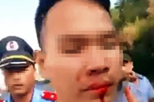 Tài xế xe 7 chỗ bị tài xế xe 30 chỗ đấm vỡ miệng