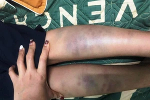 Học sinh lớp 1 bầm tím chân tay sau khi đi học về