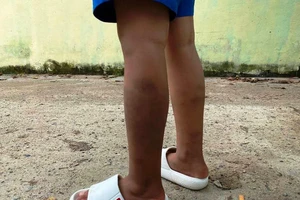 Vụ học sinh lớp 1 bị đánh bầm tím: Công an vào cuộc điều tra