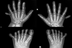 Phẫu thuật thành công cho bé gái có 12 ngón tay, 12 ngón chân