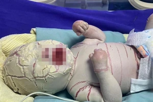 Quảng Ninh: Bé trai sinh non bị bệnh hiếm, vảy trắng toàn thân