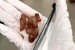 Sau khi ăn trái mận, bé trai 7 tháng tuổi phải đi cấp cứu