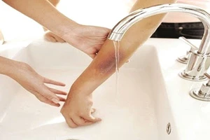 Bỏng acid: Những việc phải làm và tuyệt đối không được làm