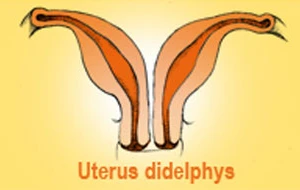 Bé gái bị dị dạng sinh dục hiếm gặp