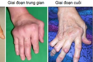Rước họa do dùng thuốc 'lang vườn' trị viêm khớp