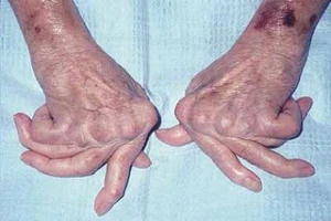 Để không tàn phế do viêm khớp dạng thấp