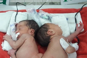 Hai bé song sinh dính liền mông, không thấy hậu môn