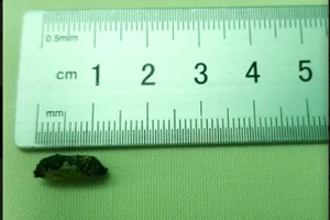 Sống kỳ diệu với mảnh bom nằm trong tim 45 năm 