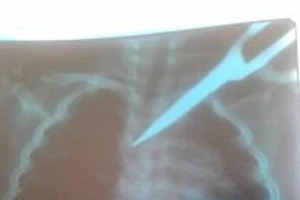 Cấp cứu kịp thời bé gái bị kéo đâm xuyên ngực