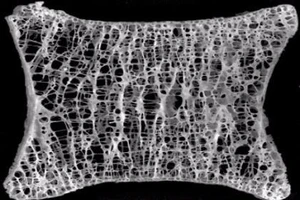 Biến chứng loãng xương dẫn đến tử vong, thương tật vĩnh viễn