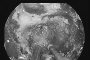 Đau đầu kéo dài, chụp MRI phát hiện u sàn sọ cực hiếm