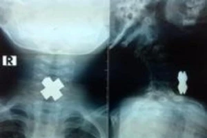 Lấy dị vật hình chữ thập trong thực quản bé trai 3 tuổi