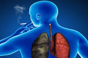 Số người chết do COPD vượt qua số người chết do ung thư