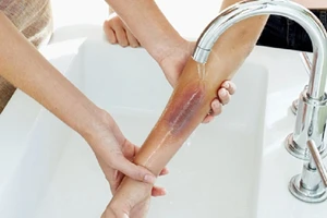 Dội nước đá vào người bỏng vì nổ bốt điện liệu có đúng?