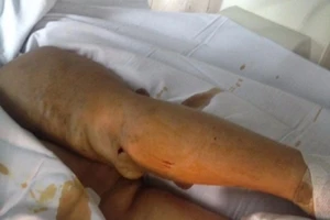 Phục hồi cánh tay trái bị liệt hơn 40 năm