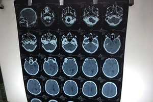 BV quận 11 mổ thành công chấn thương sọ não