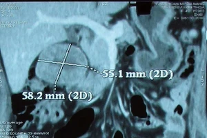 90% u ở thận là ung thư