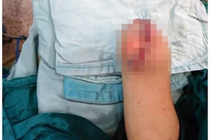 Nổ cục sạc điện, bé 3 tuổi bị mất bàn tay và một mắt