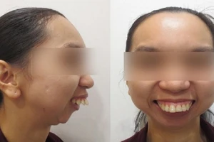 Lần phẫu thuật thứ 46 của cô gái “răng chuột” 