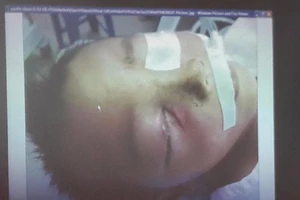 Cứu sống bé 3 tuổi bị súng bắn vào mắt