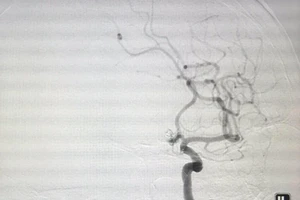 Xuyên đêm cứu bệnh nhân bị liệt có thể cử động