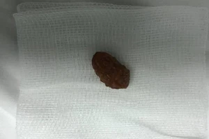 Bé trai suýt chết vì hạt xí muội lọt vào phế quản