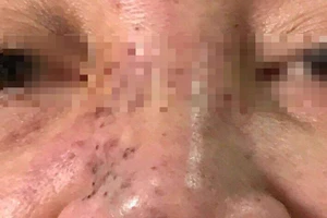 Hoại tử mặt do tiêm chất làm đầy ở Spa 'dỏm'