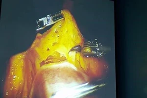 Lần đầu tiên dùng robot phẫu thuật ung thư dạ dày