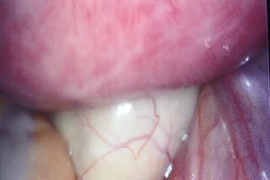 Cứu sản phụ bị u buồng trứng xoắn, kích thước khủng