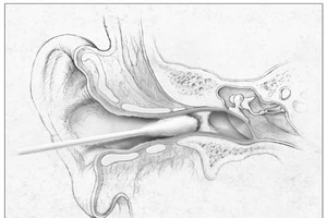 Rủ nhau đi bơi rồi rủ nhau nhập viện vì viêm tai ngoài