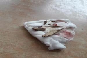 Mảnh gỗ 6cm trong mắt, 1 năm đi khám không phát hiện ra