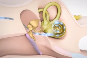 Nhiều cơ hội cấy ốc tai chữa điếc bẩm sinh cho trẻ em