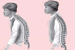 Tại sao dùng canxi đắt tiền vẫn bị loãng xương?