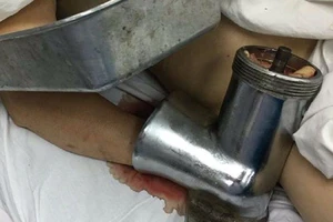 1 phụ nữ nhập viện với máy xay thịt dính vào tay