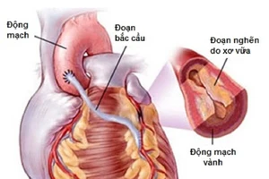 Lần đầu phẫu thuật tim mạch không cần chẻ xương ức
