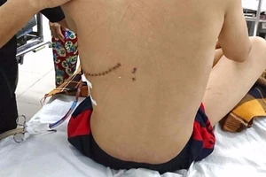 Báo động đỏ cứu bệnh nhi bị kéo găm vào lưng