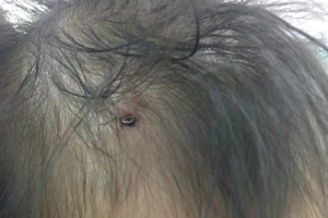 Hy hữu: Bé 19 tháng tuổi bị đinh cắm vào đầu