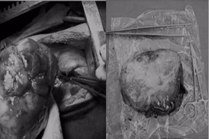 Cắt khối u hiếm gặp nặng 1,2kg trong phổi bé trai