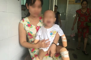 Bé 2 tuổi phải cắt 4 chi vì viêm não mô cầu