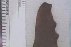 Thở không nổi mới biết răng giả chui vào phổi đã 2 năm