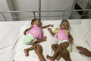 Gần 400 ngày chuẩn bị tách cặp song sinh dính liền