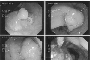BV Đại học Y dược TP.HCM: Trị ung thư không cần phẫu thuật