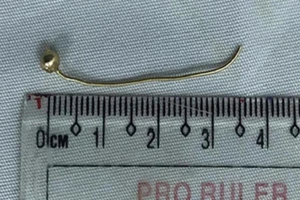 Bé 7 tháng rách thực quản do nuốt hoa tai bằng vàng