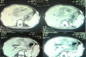 Kỳ lạ: Bác sĩ hy vọng khối u của bệnh nhi là u ác tính