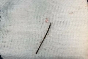 Cây kim 'rong chơi' 2 năm trong tim, phổi bé 3 tuổi