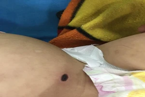 2 trẻ nguy kịch cùng có vết đốt lạ ở bụng
