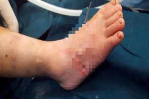  Người lớn sơ ý, bé 2 tuổi bị máy làm miến cắt lìa chân